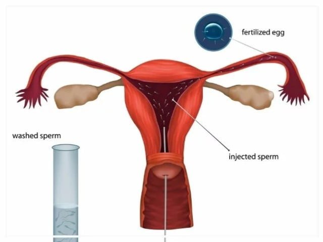 Artificial insemination IUI