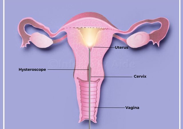 Hysteroscopy before IVF