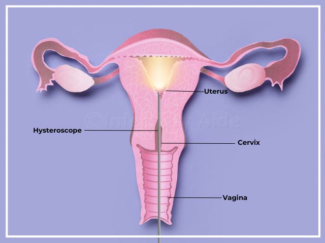Hysteroscopy before IVF
